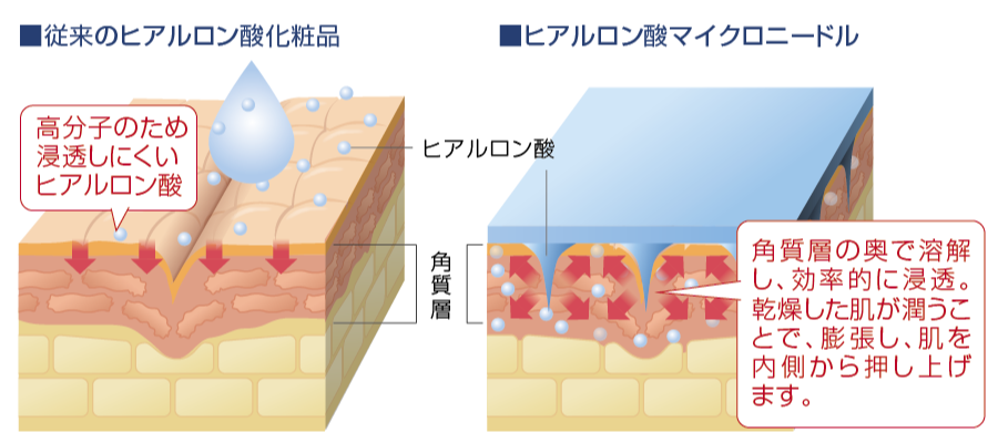 ヒアルロン酸マイクロニードル